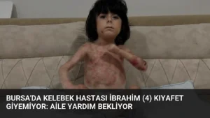 Bursa'da Kelebek Hastası İbrahim (4) Kıyafet Giyemiyor: Aile Yardım Bekliyor