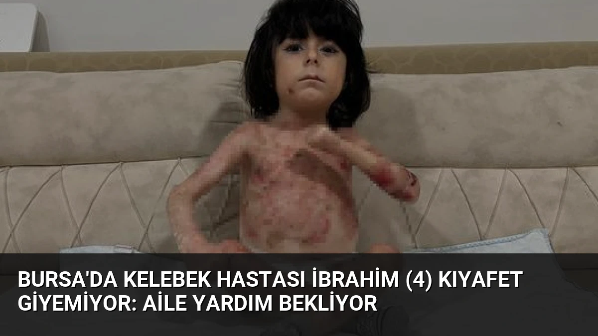 Bursa’da Kelebek Hastası İbrahim (4) Kıyafet Giyemiyor: Aile Yardım Bekliyor