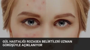 Gül Hastalığı Rozasea Belirtileri Uzman Görüşüyle Açıklanıyor