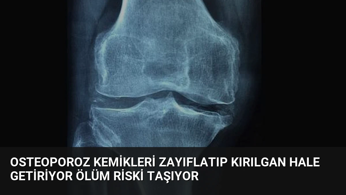 Osteoporoz Kemikleri Zayıflatıp Kırılgan Hale Getiriyor Ölüm Riski Taşıyor