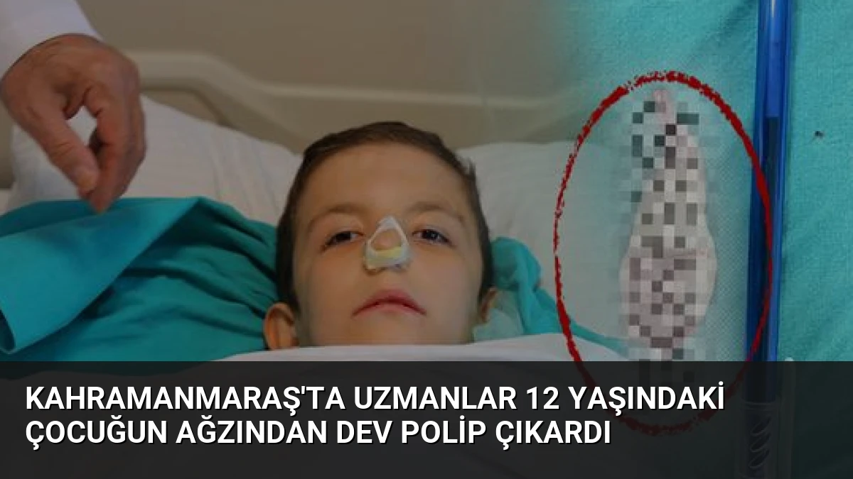 Kahramanmaraş’ta Uzmanlar 12 Yaşındaki Çocuğun Ağzından Dev Polip Çıkardı